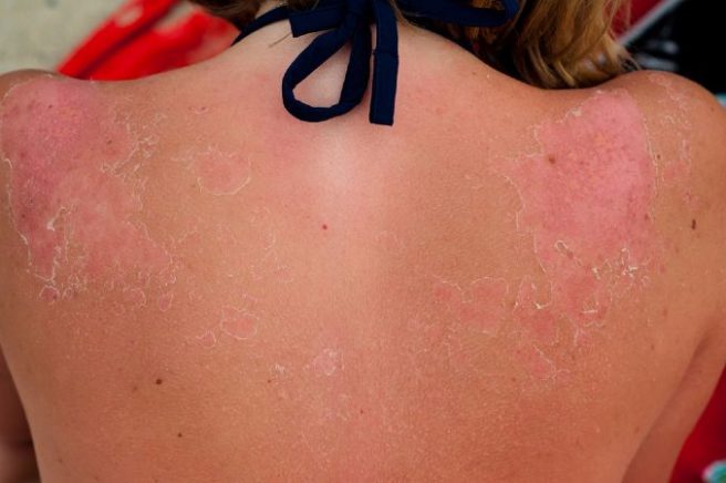 sunburn-solutions-5-simple-ways-to-treat-your-damaged-skin-at-home